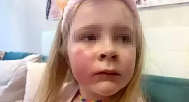 Öptüğü Kızının Yanağı Yandı: Benim Hatamı Yapmayın